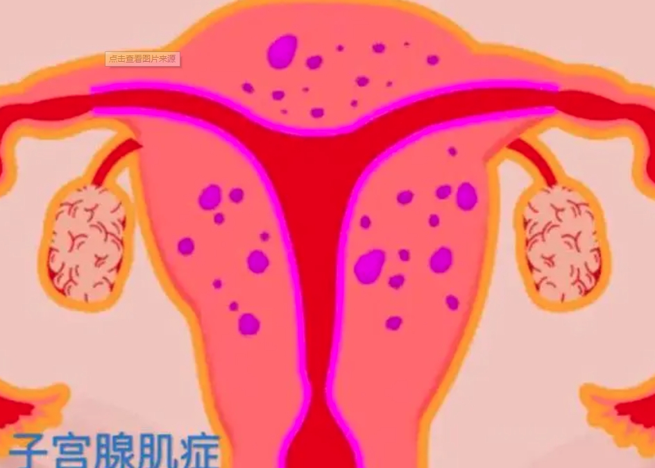 转载：SOGC临床实践指南：子宫腺肌症的诊断与治疗