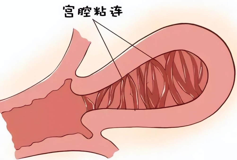 转载：最新研究发表：温敏水凝胶作为MSC-EVs的缓释载体，有效提升宫腔粘连的治疗效果