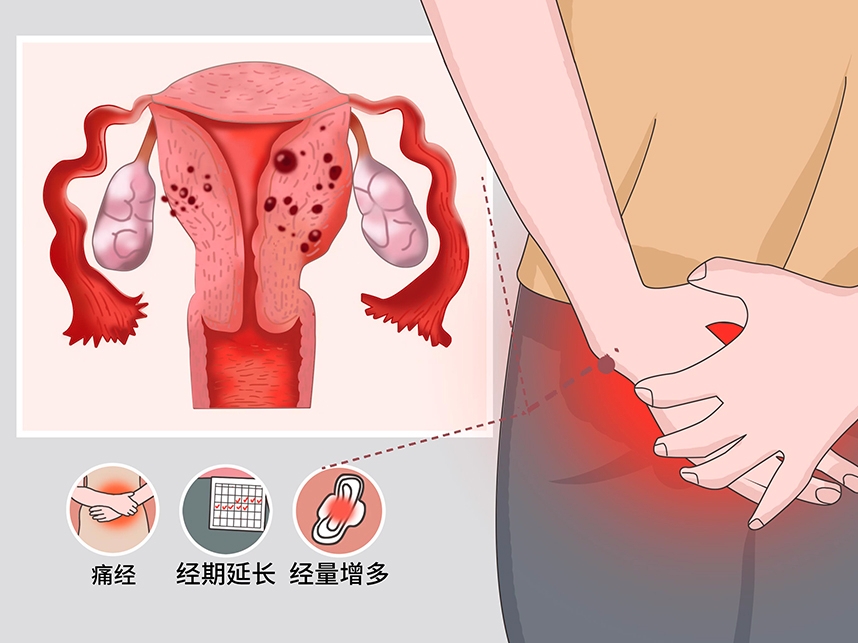 转载：子宫腺肌病合并盆腔子宫内膜异位症的保育策略及全程管理