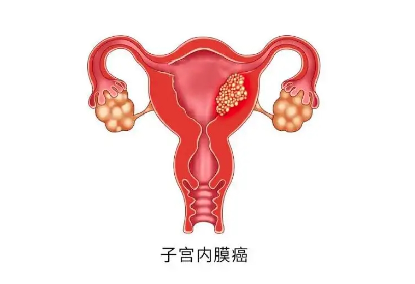 转载：中国声音·华西经验分享 | 郑莹教授团队：分子分型助力子宫内膜癌保留生育功能治疗
