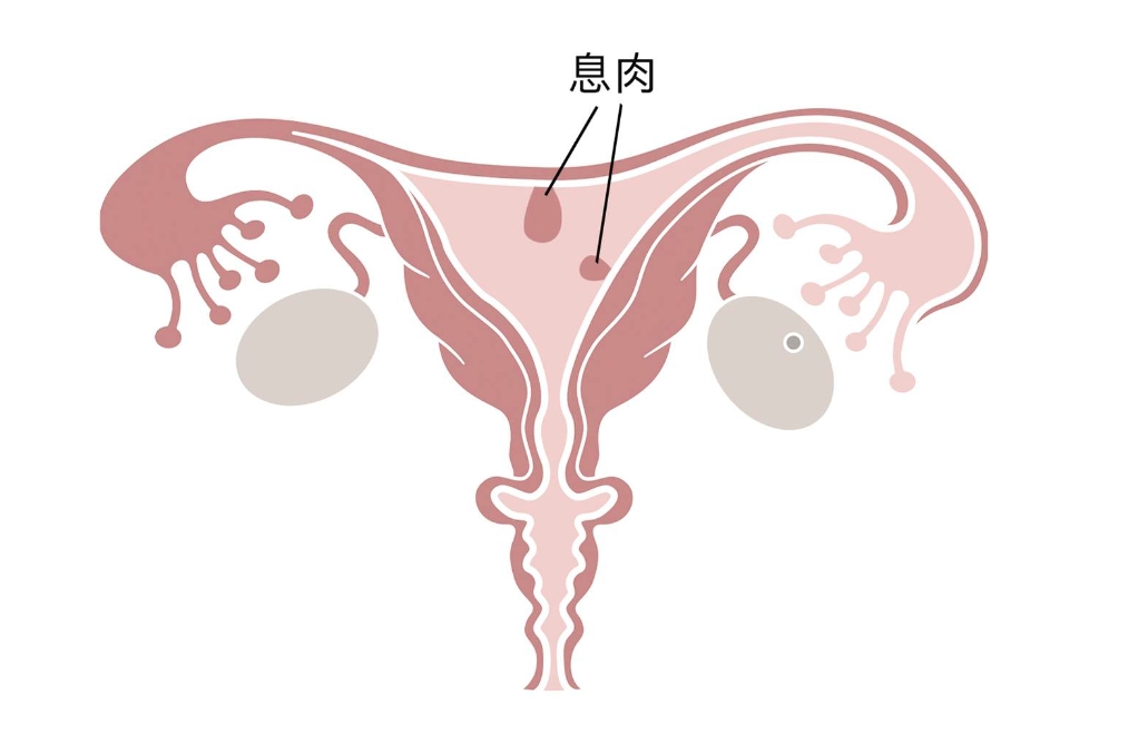 转载：子宫内膜息肉个体化管理案例