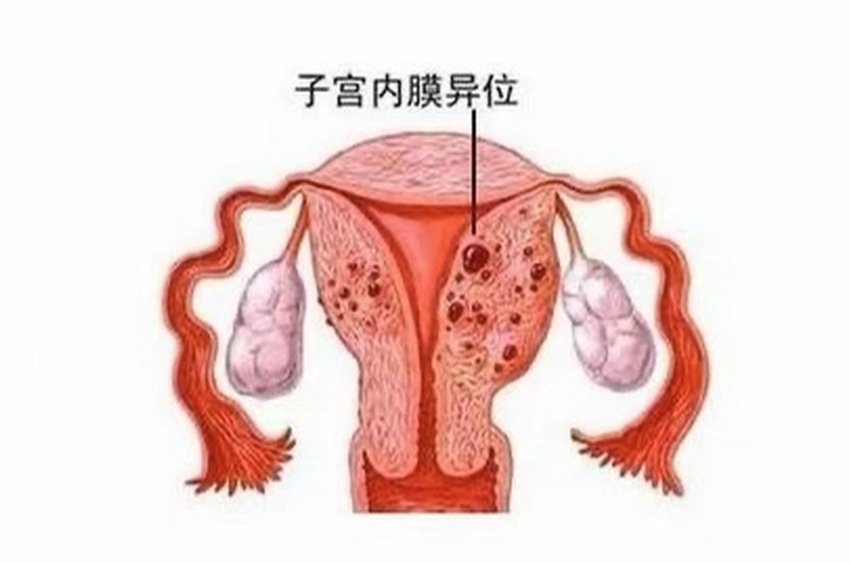 什么是子宫内膜异位症