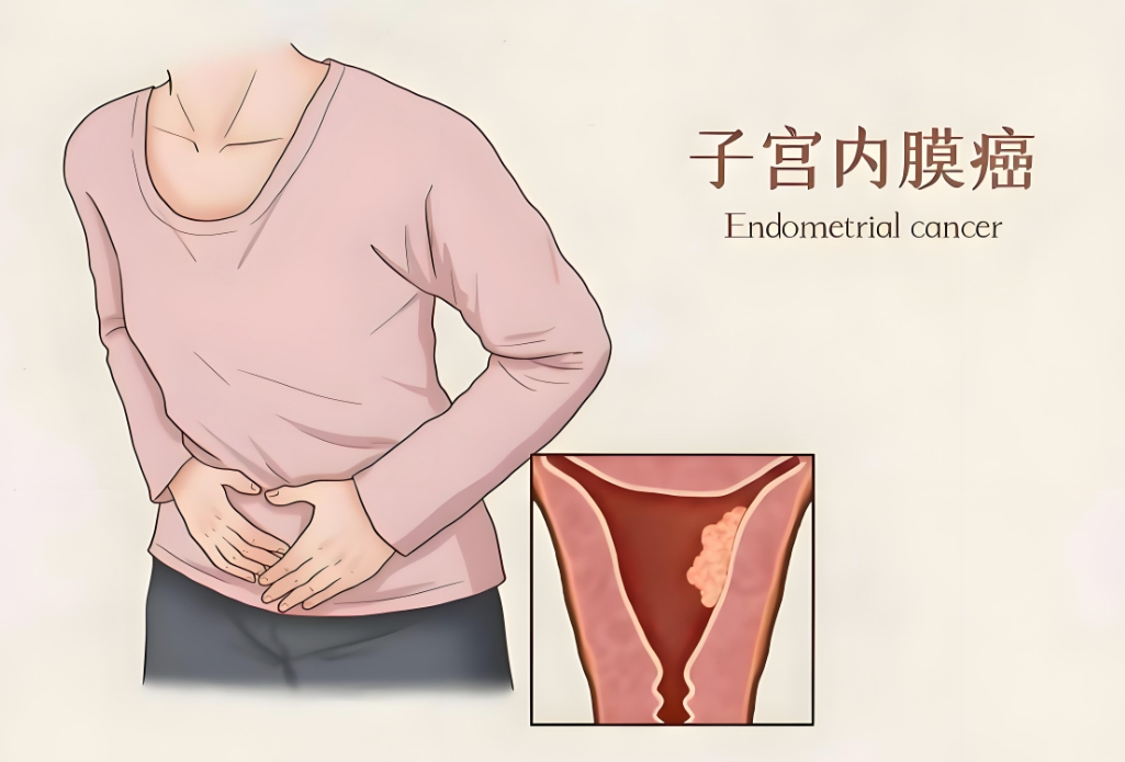 转载：专家共识 | 宫腔镜子宫内膜癌形态特征在保留生育功能治疗中作用的中国专家共识