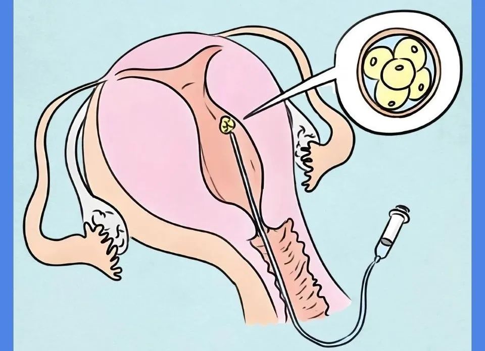 「海南试管婴儿条件」试管婴儿是亲生的吗？