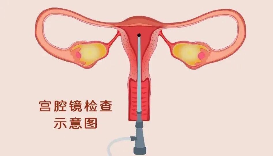 「试管婴儿」薄形子宫内膜还有机会增厚吗？