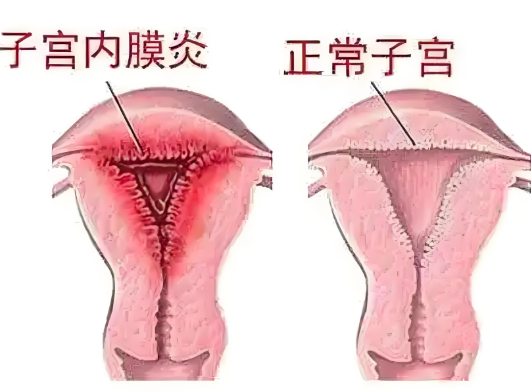 「试管婴儿」子宫内膜炎能自愈吗？会不会复发？