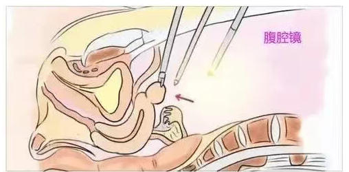 「试管婴儿」试管助孕前一定要做宫腔镜或腹腔镜吗？